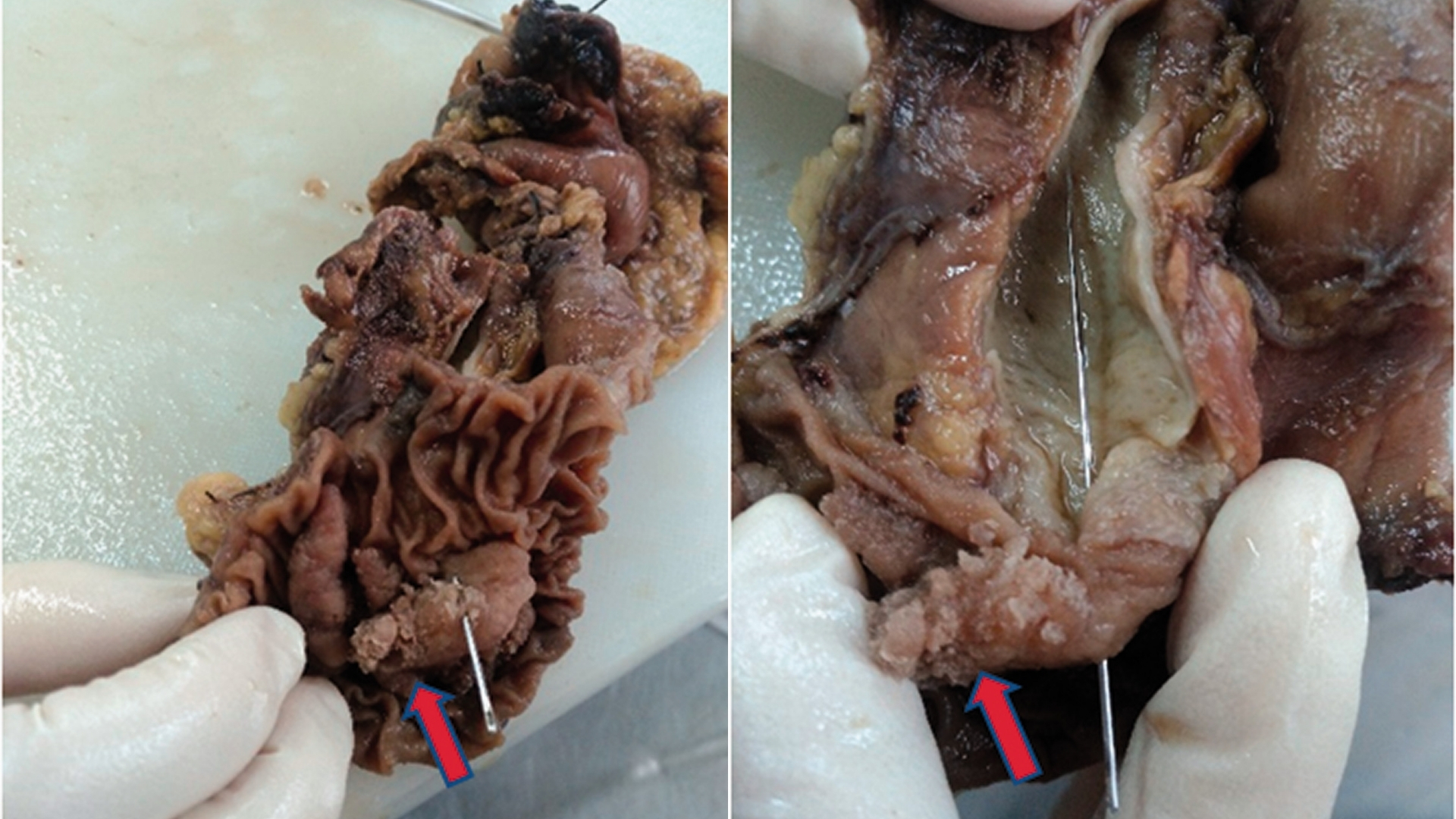Ampullary Cancer