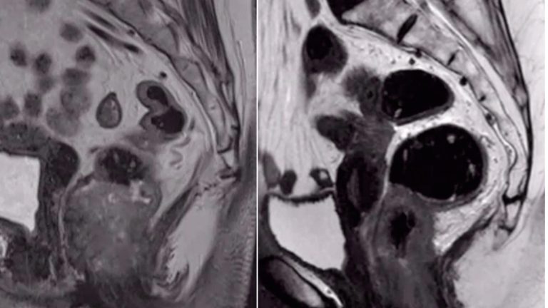 Anal Cancer (Anal Carcinoma)