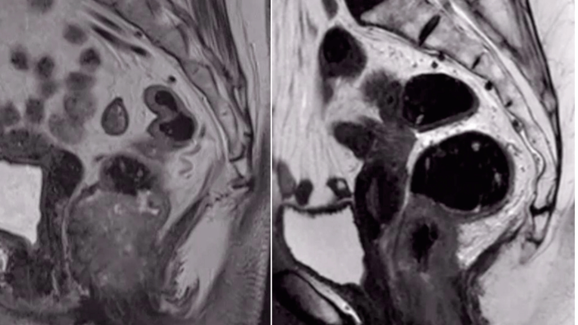 Anal Cancer (Anal Carcinoma)