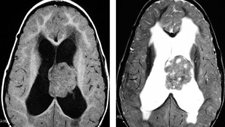 Atypical Teratoid Rhabdoid Tumor (ATRT)