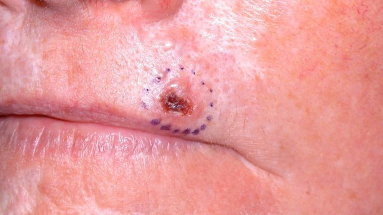 Basal Cell Skin Cancer (Basal Cell Carcinoma)