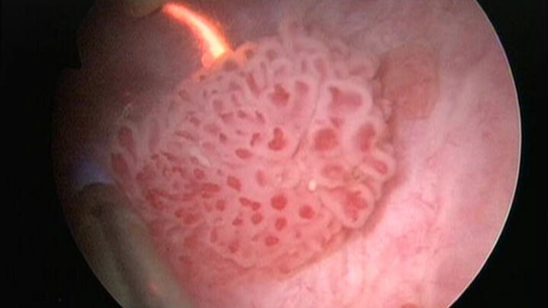 Bladder Cancer (Urothelial Carcinoma Of The Bladder)