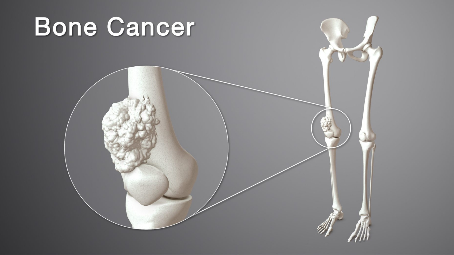 Bone Cancer (Osteosarcoma)