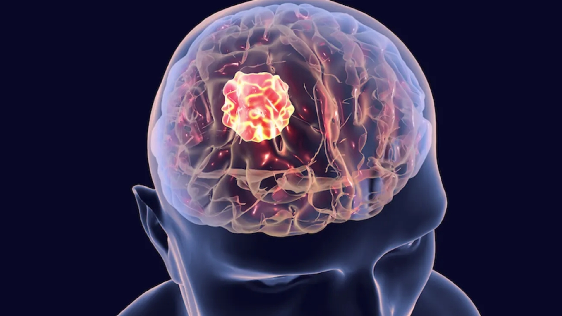 Brain Cancer (Malignant Brain Tumor)