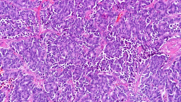 Carcinoid Tumor (Neuroendocrine Tumor)