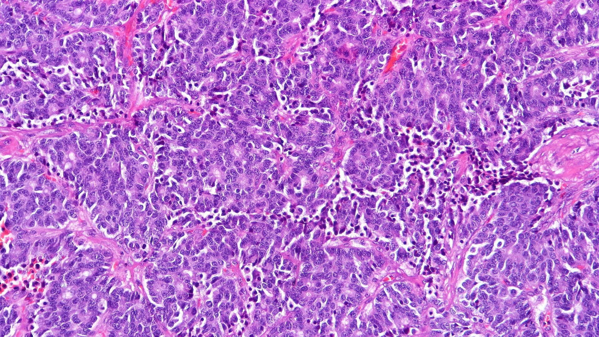 Carcinoid Tumor (Neuroendocrine Tumor)