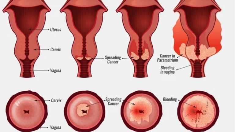 Cervical Cancer (Cervical Carcinoma)