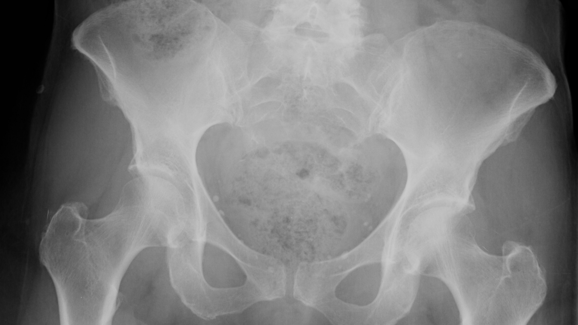 Chordoma (Chordoid Bone Tumor)