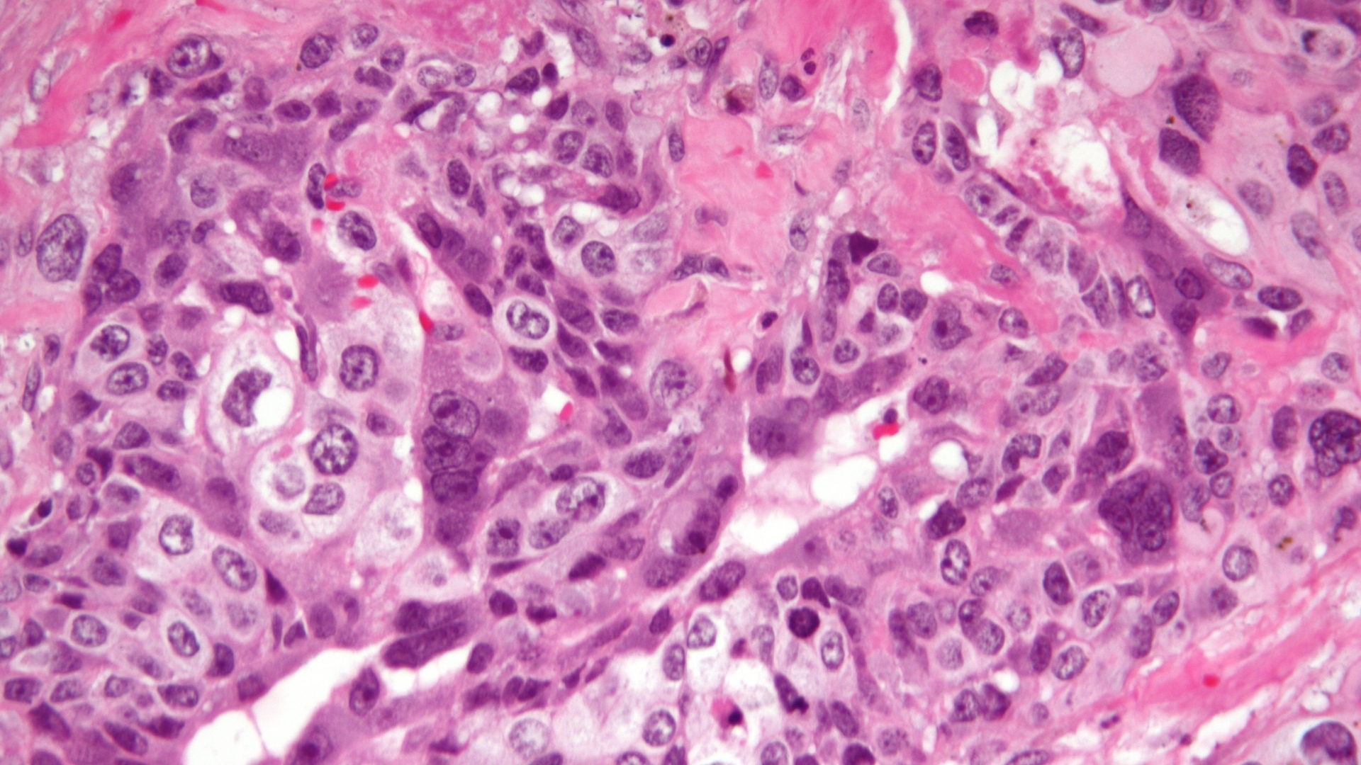 Choriocarcinoma (Gestational Trophoblastic Tumor)