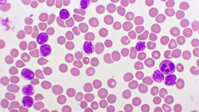 Chronic Lymphocytic Leukemia (CLL)