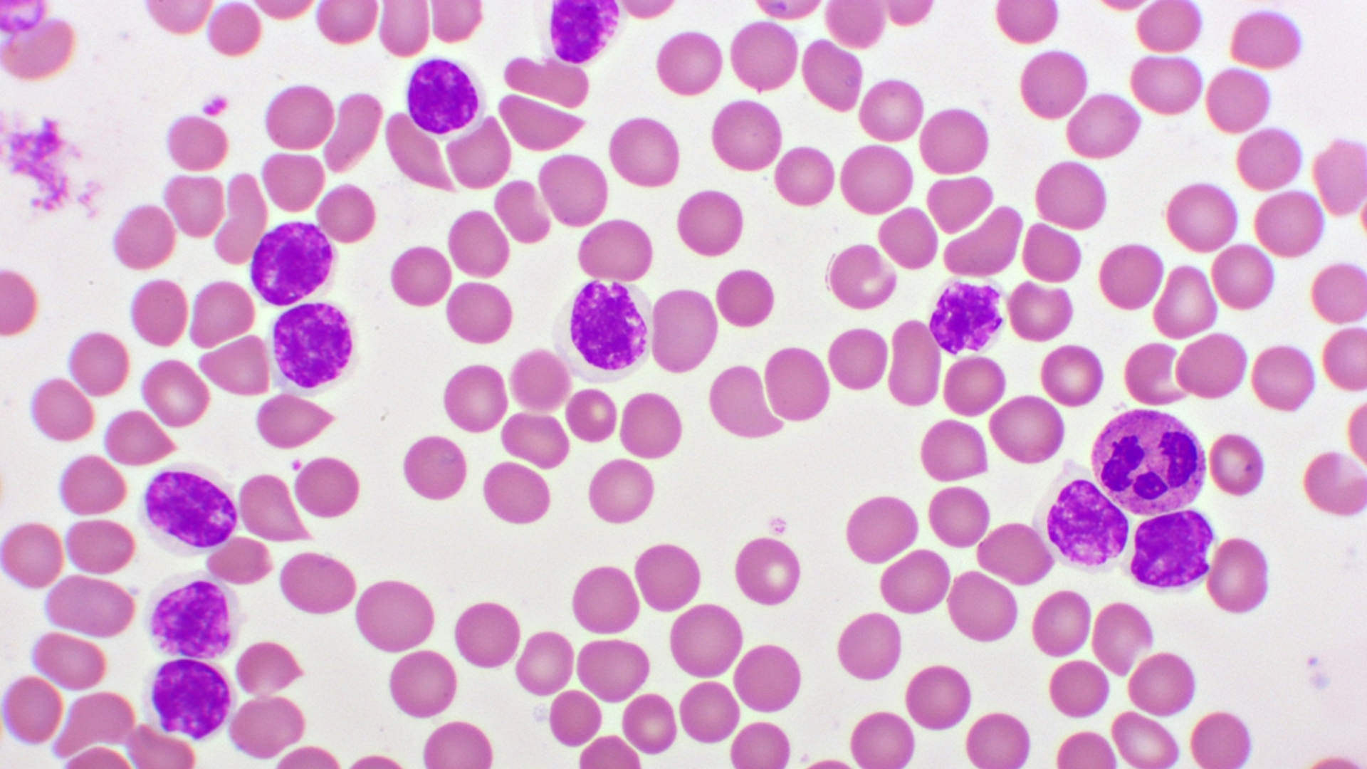 Chronic Lymphocytic Leukemia (CLL)