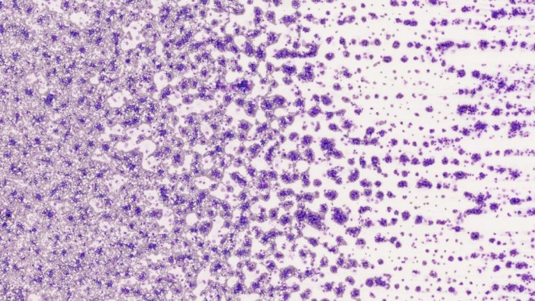 Chronic Myelogenous Leukemia (CML)