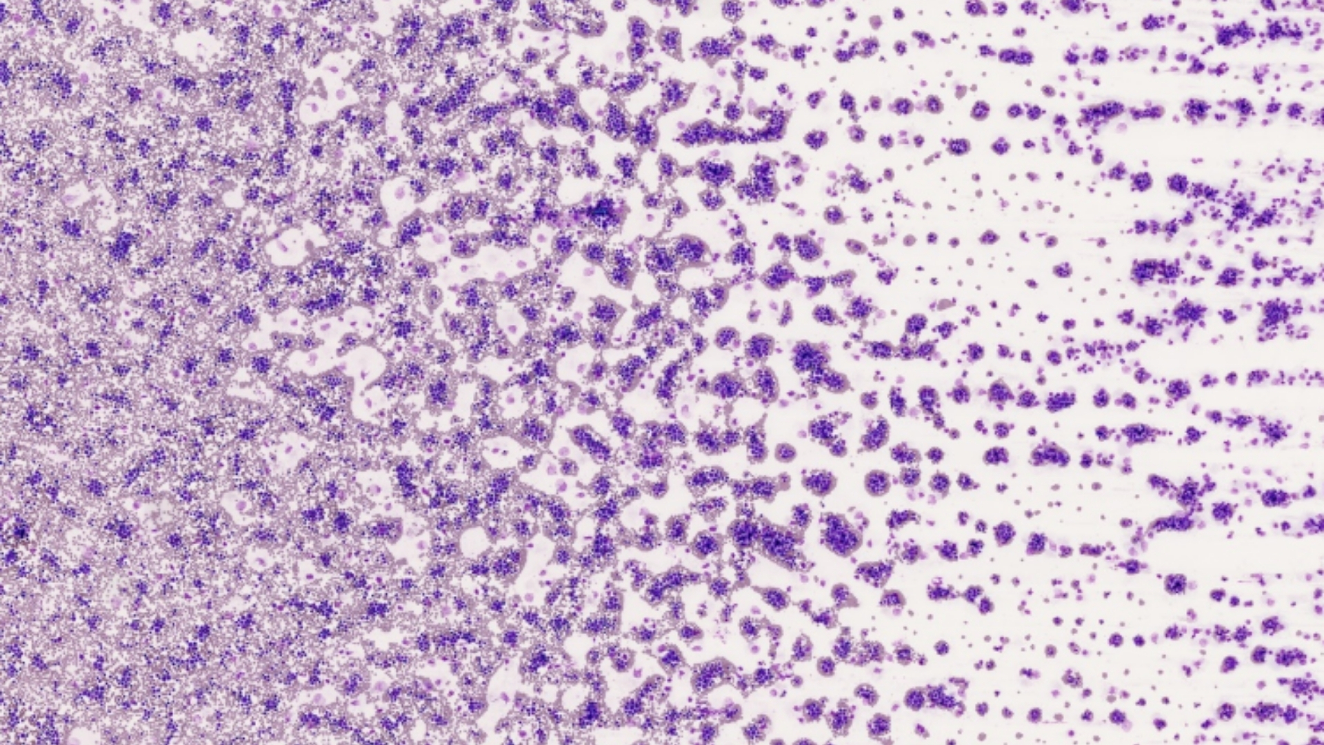 Chronic Myelogenous Leukemia (CML)