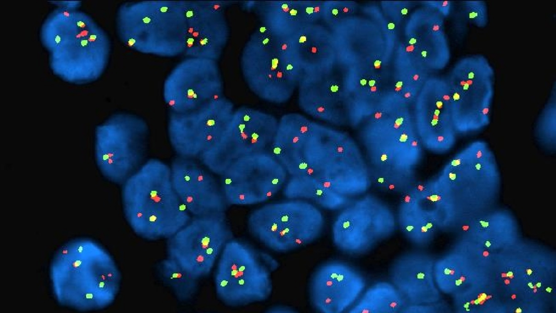 Desmoplastic Small Round Cell Tumor (DSRCT)