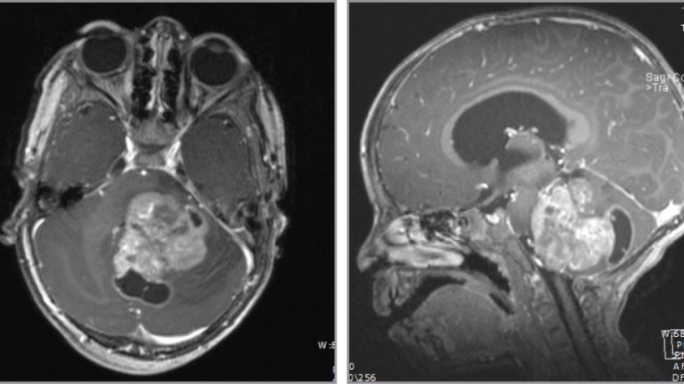 Diffuse Intrinsic Pontine Glioma (DIPG)