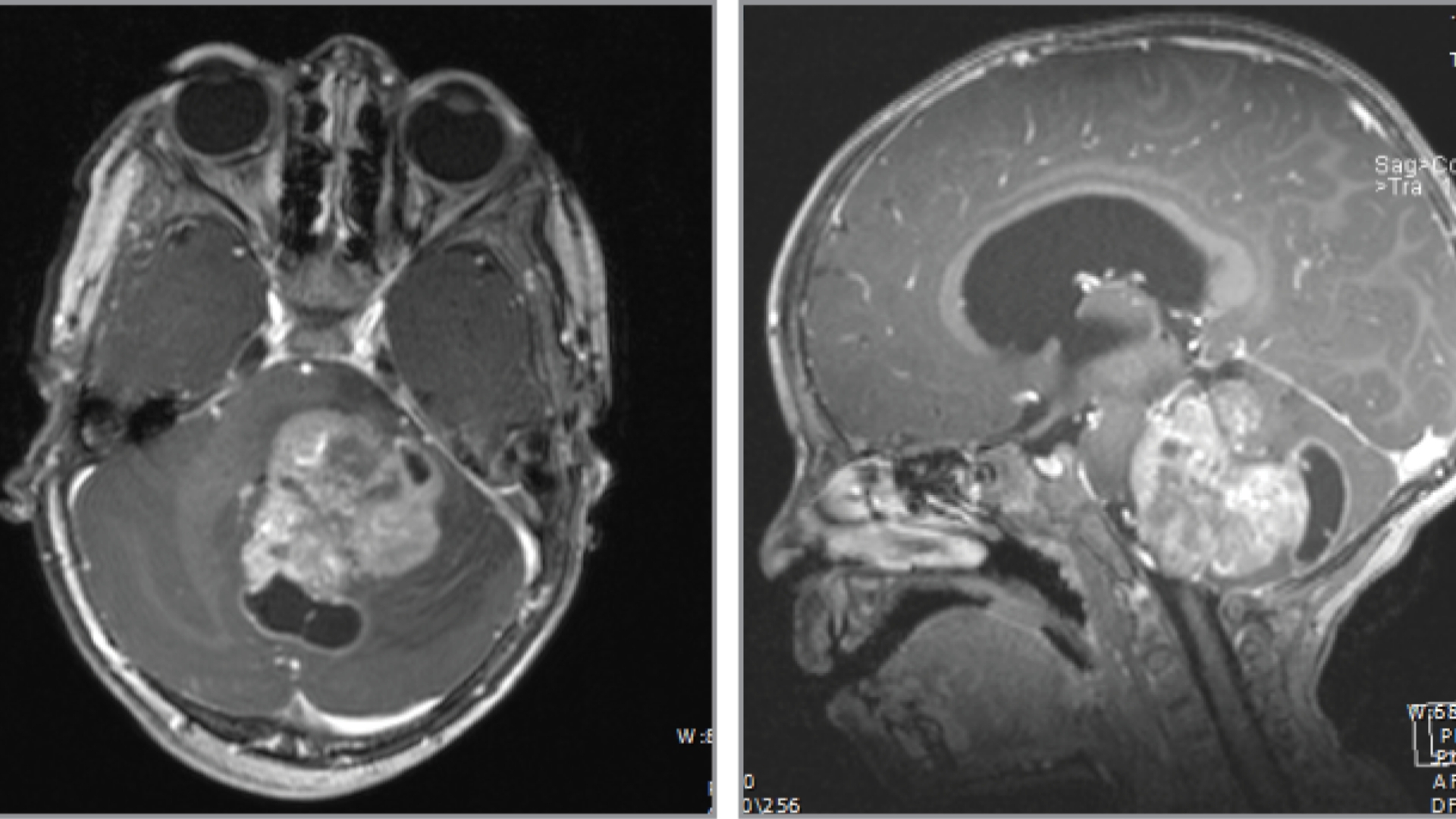 Diffuse Intrinsic Pontine Glioma (DIPG)
