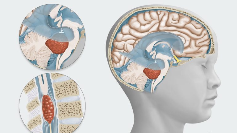 Ependymoma (Ependymal Brain Tumor)