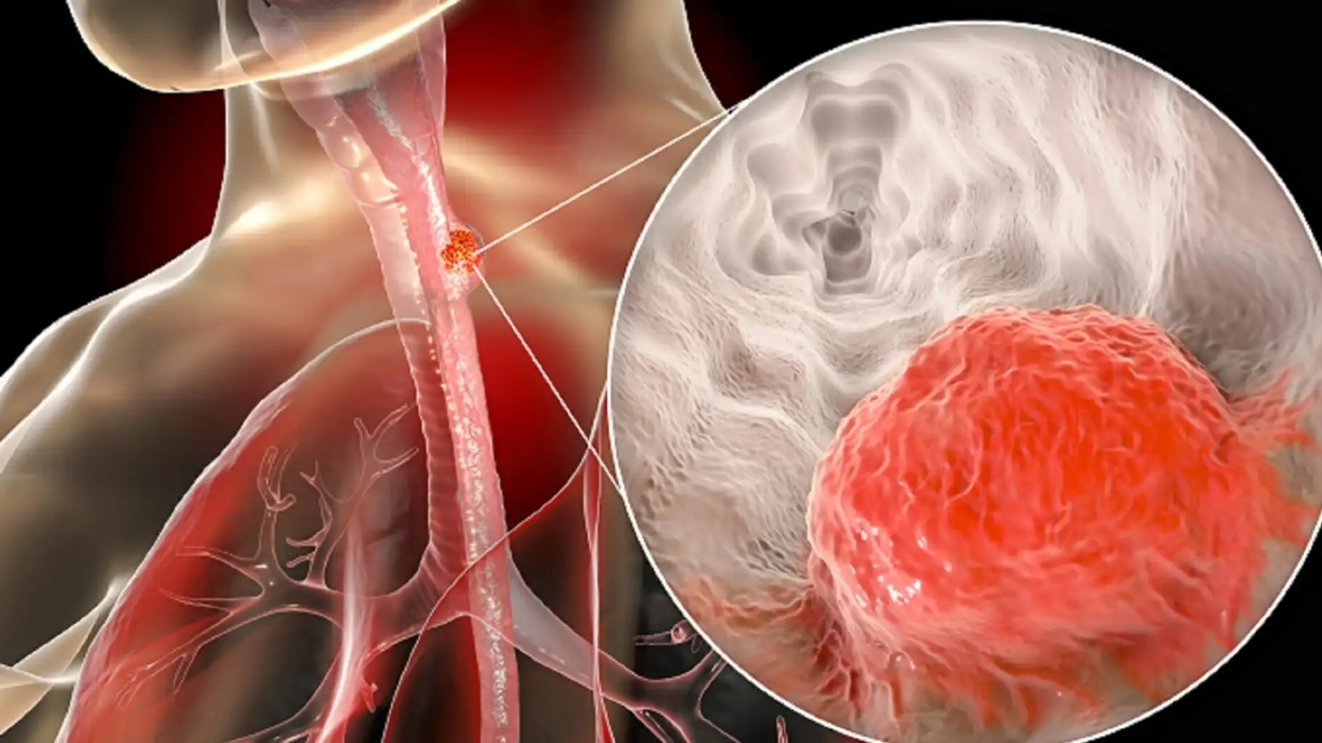 Esophageal Cancer (Esophageal Carcinoma)