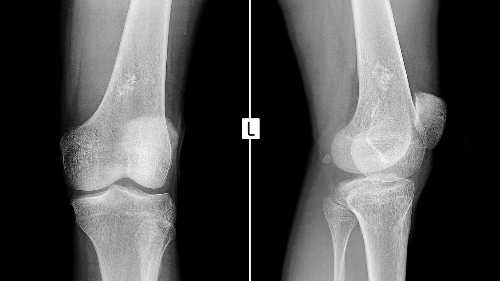 Ewing Sarcoma (Bone Sarcoma)