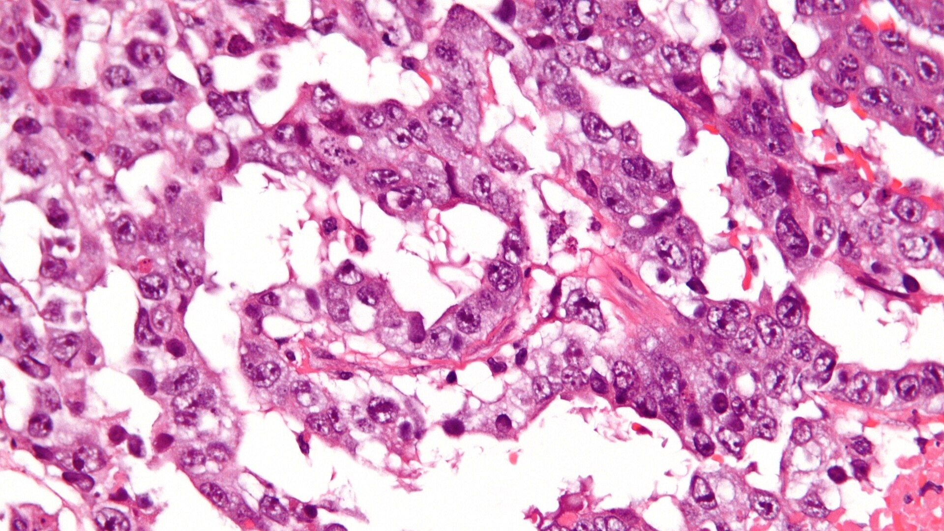Extragonadal Germ Cell Tumor (EGCT)
