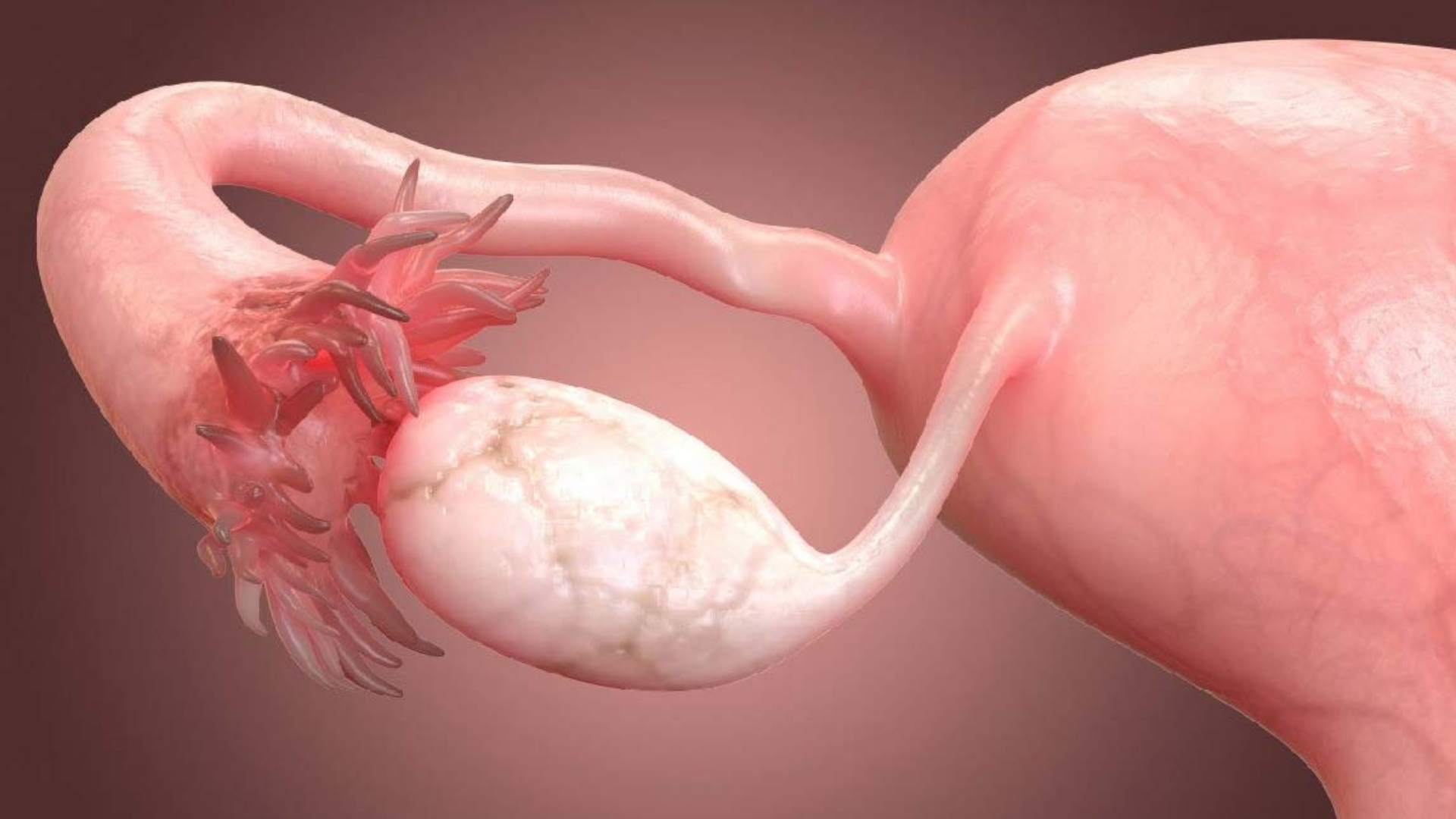 Fallopian Tube Cancer (Fallopian Tube Carcinoma)