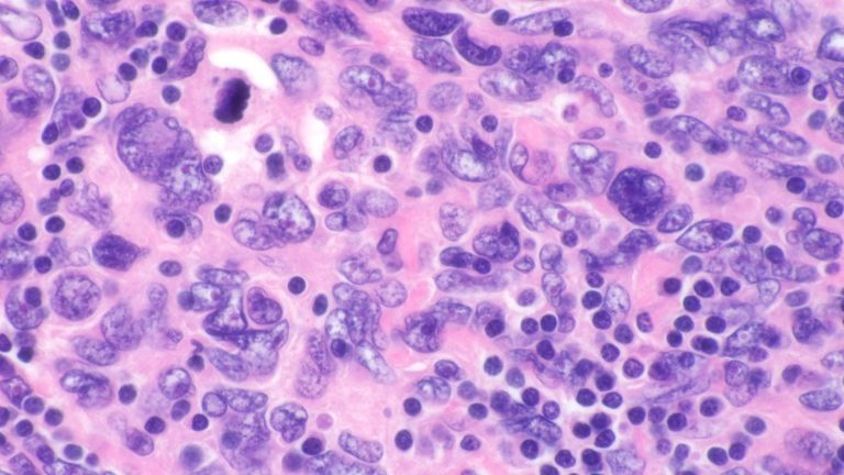 Follicular Dendritic Cell Sarcoma (FDCS)