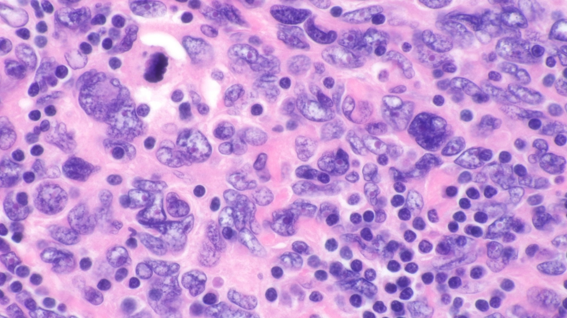 Follicular Dendritic Cell Sarcoma (FDCS)