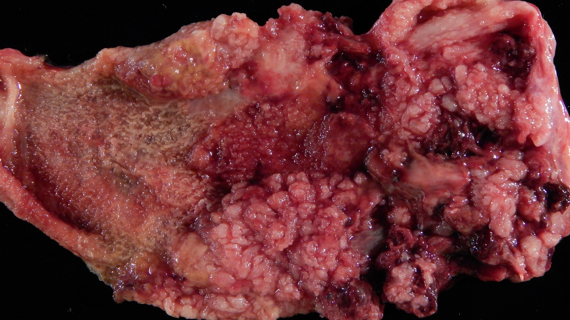 Gallbladder Cancer (Gallbladder Carcinoma)