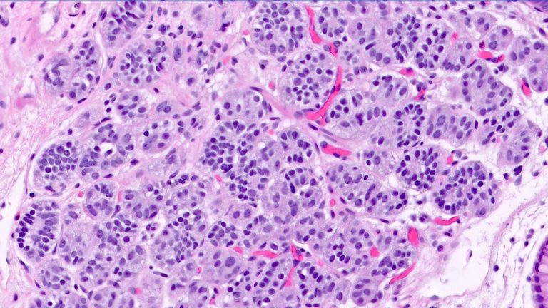 Gastrointestinal Neuroendocrine Tumor (Carcinoid Tumor)