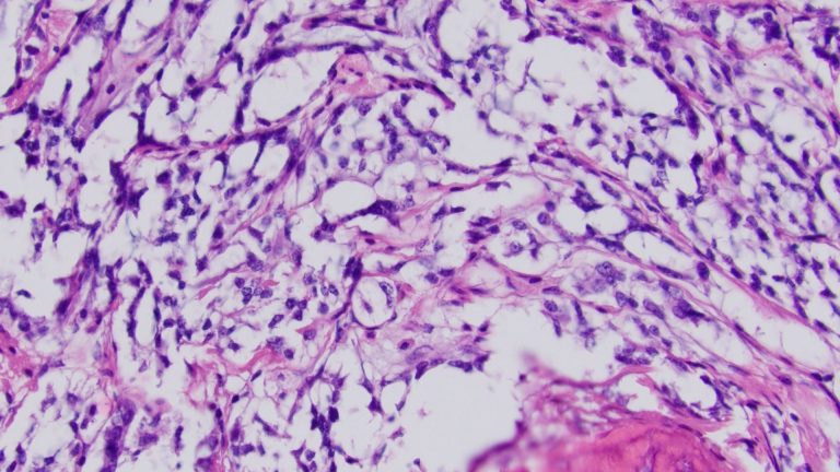 Gastrointestinal Stromal Tumor (GIST)