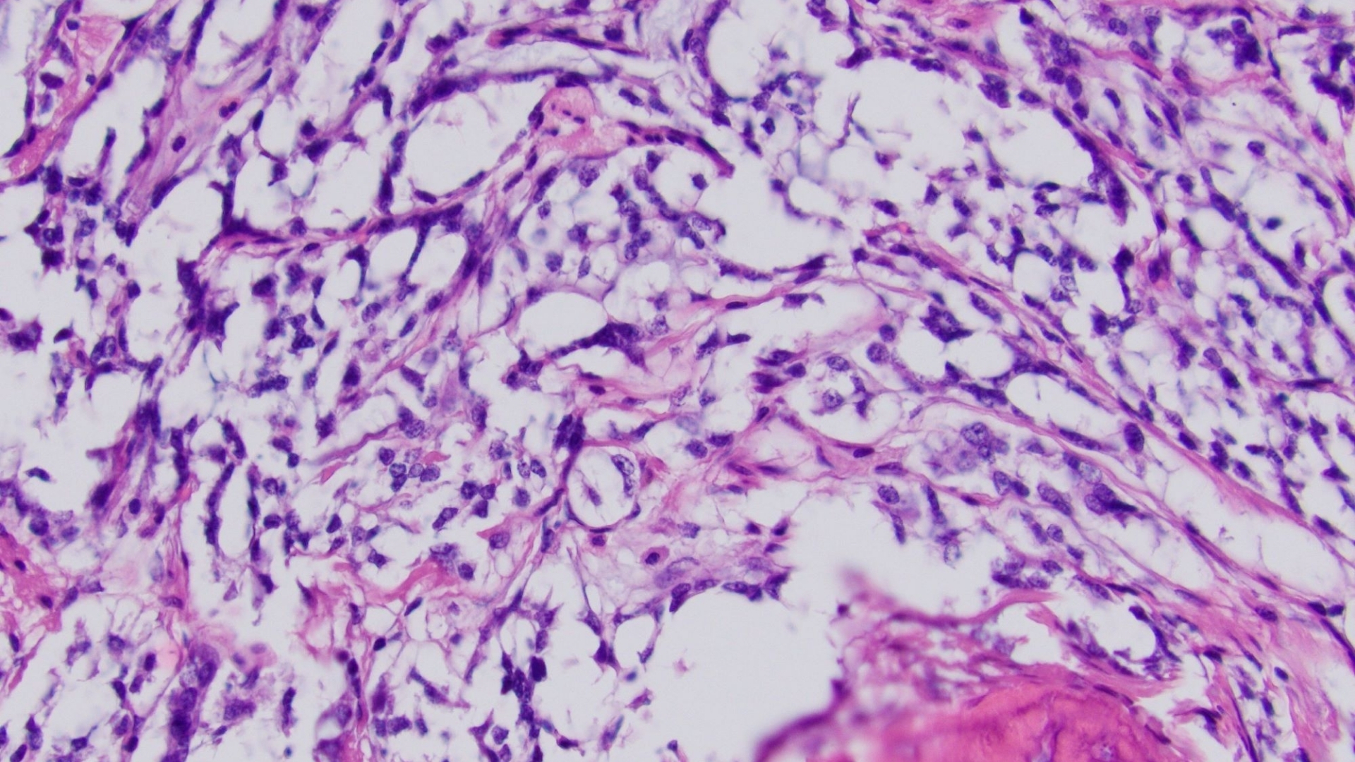 Gastrointestinal Stromal Tumor (GIST)
