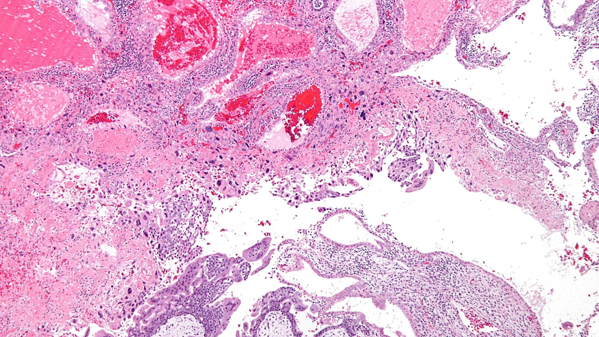 gestational-trophoblastic-disease-gtd