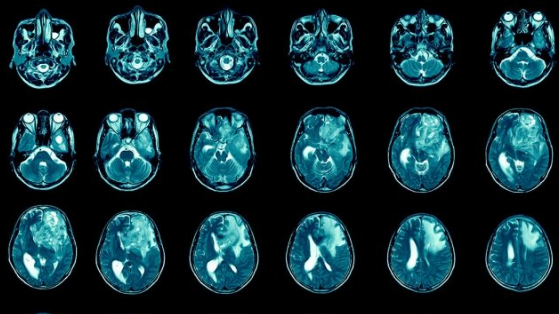 Glioblastoma (GBM)