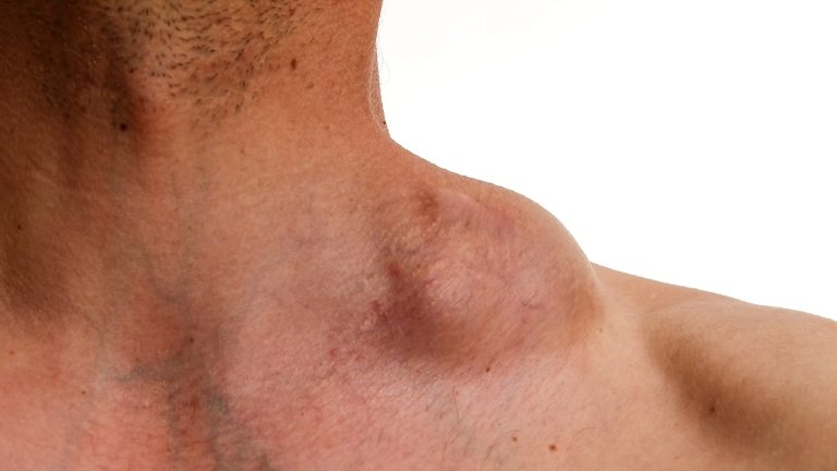 Hodgkin Lymphoma (Hodgkin Disease)