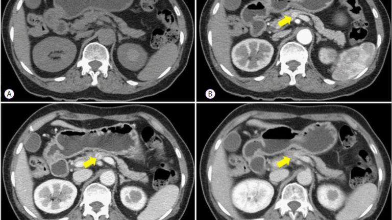 islet-cell-tumor-pancreatic-neuroendocrine-tumor