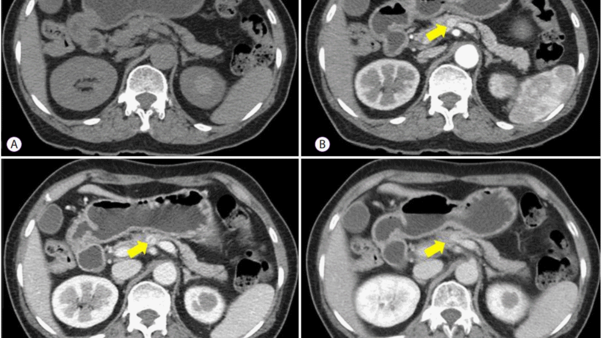 islet-cell-tumor-pancreatic-neuroendocrine-tumor