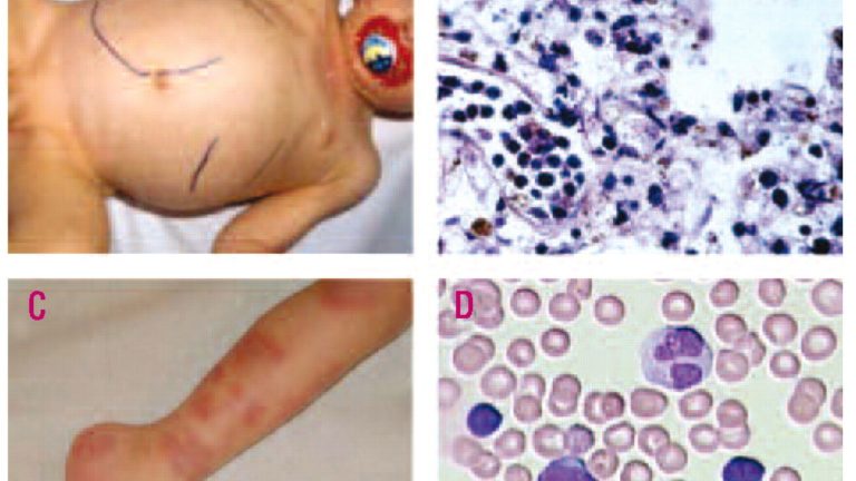 juvenile-myelomonocytic-leukemia-jmml