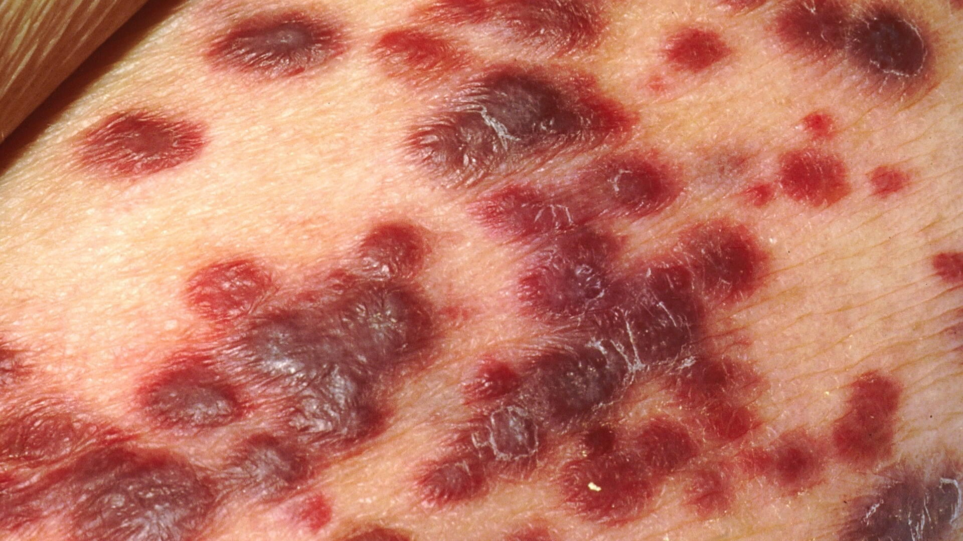 Kaposi Sarcoma (KS)
