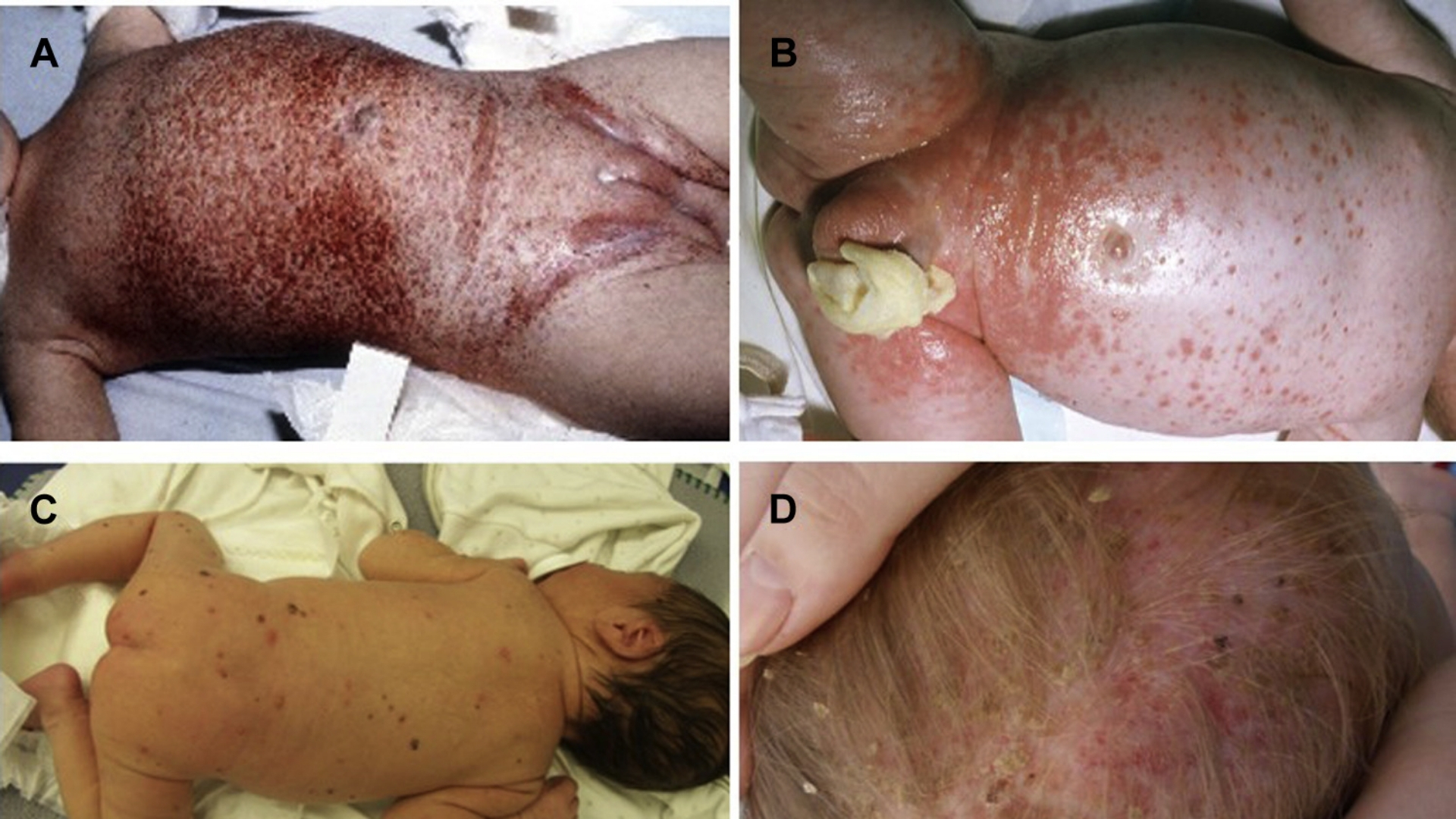Langerhans Cell Histiocytosis (LCH)