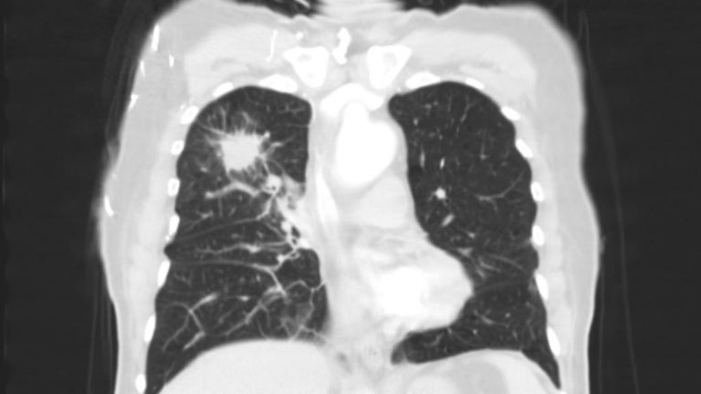 Lung Cancer (Bronchogenic Carcinoma)