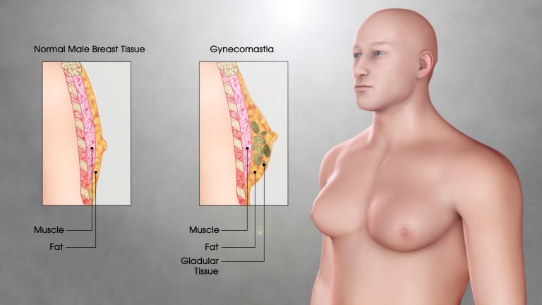 Male Breast Cancer (Male Breast Carcinoma)