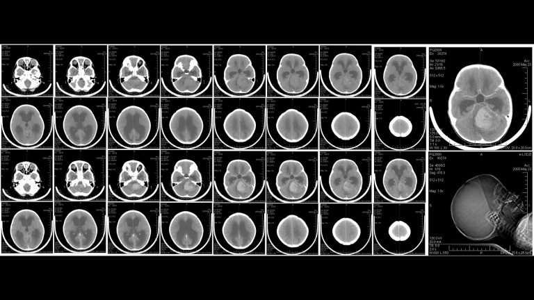 Medulloblastoma