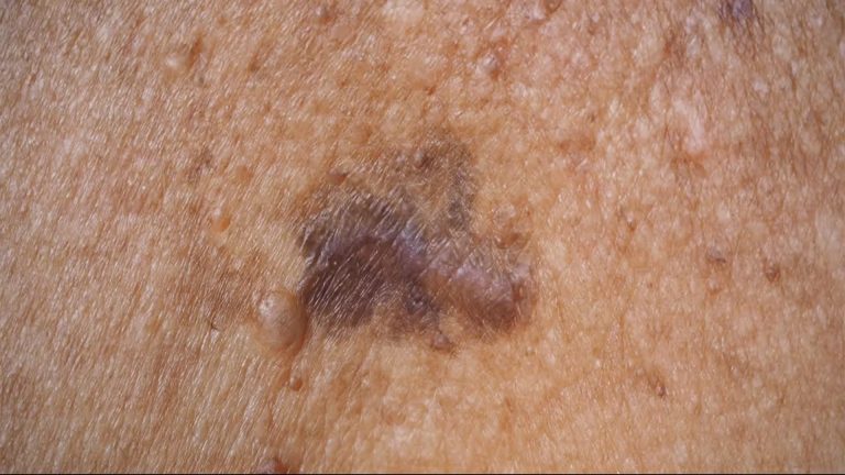 melanoma-malignant-melanoma