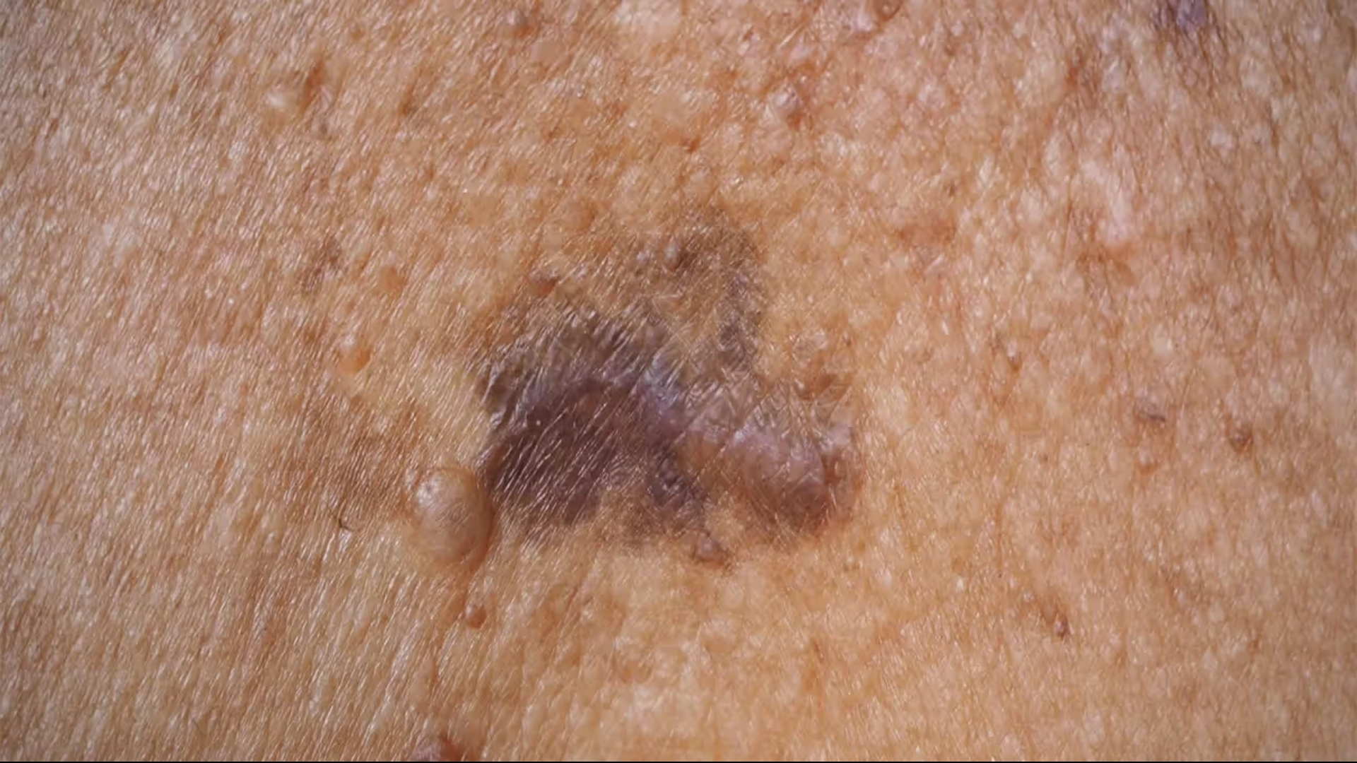 melanoma-malignant-melanoma
