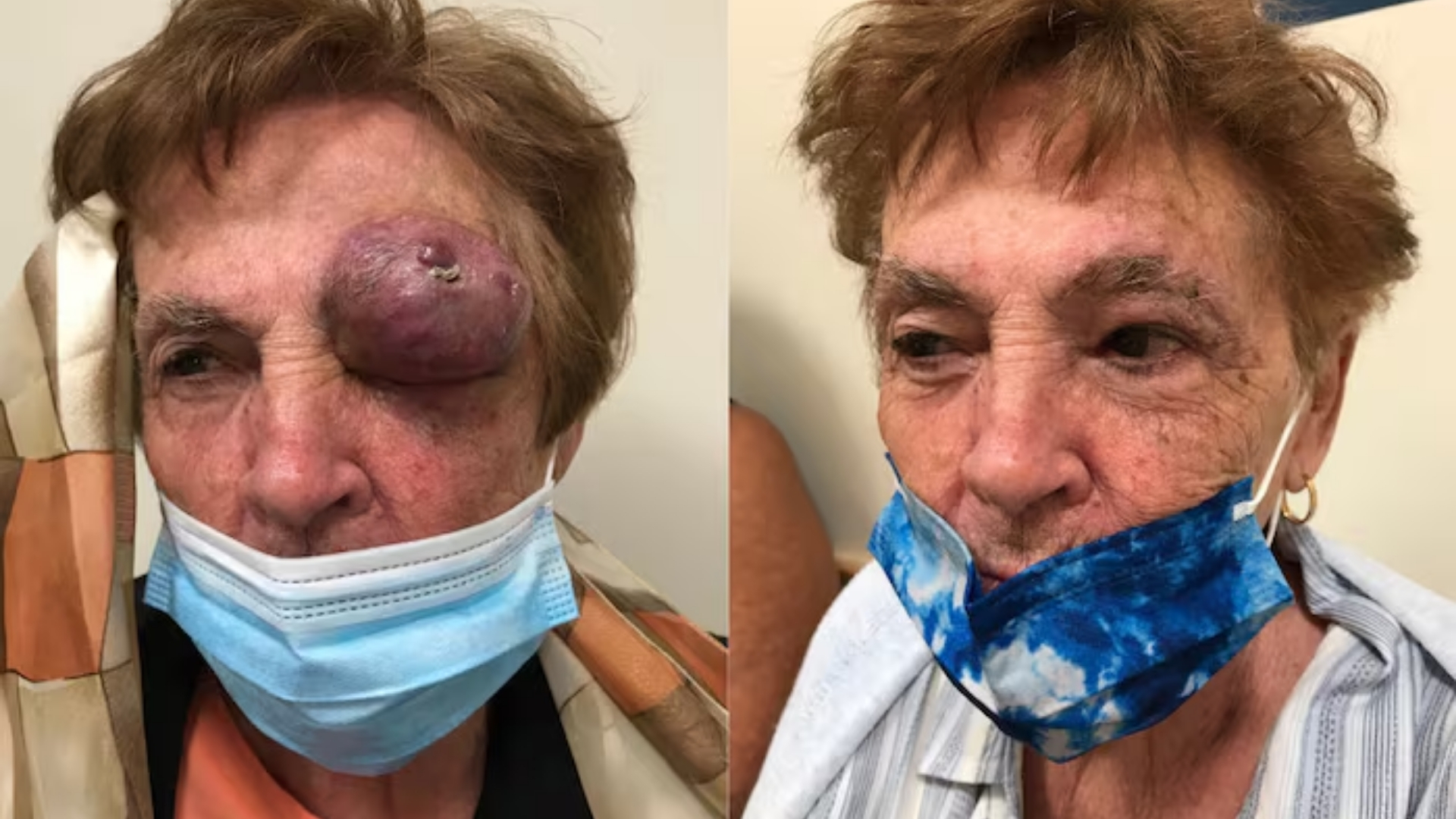 Merkel Cell Carcinoma (Merkel Cell Skin Cancer)