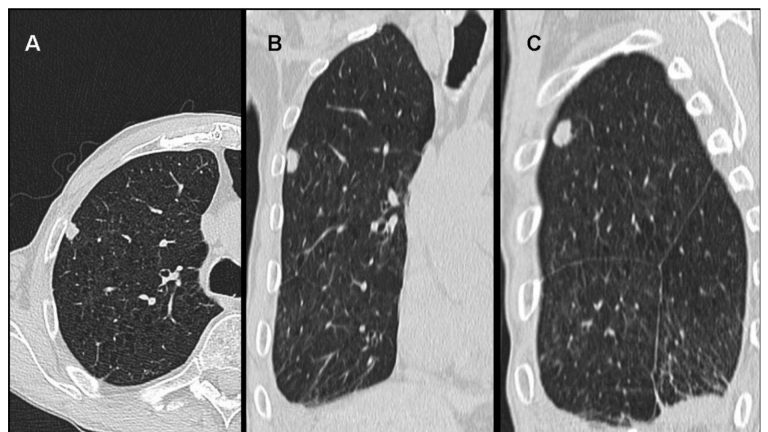 Mesothelioma (Malignant Mesothelioma)