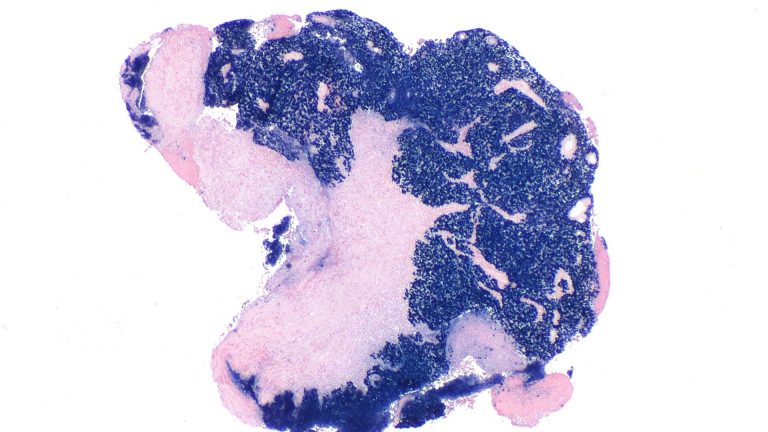 nasopharyngeal-cancer-nasopharyngeal-carcinoma