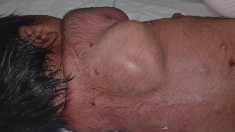 Neuroblastoma