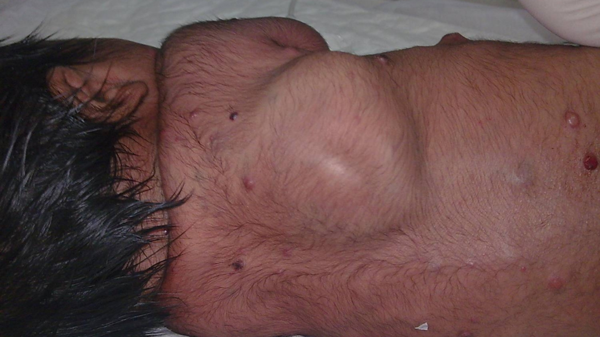 Neuroblastoma