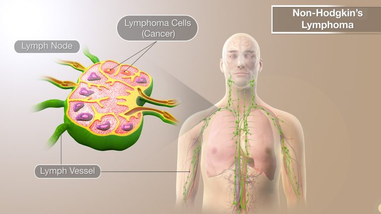 Non-Hodgkin Lymphoma (NHL)